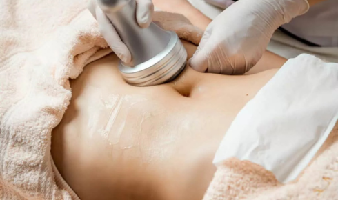 laser liposuction Winnipeg
