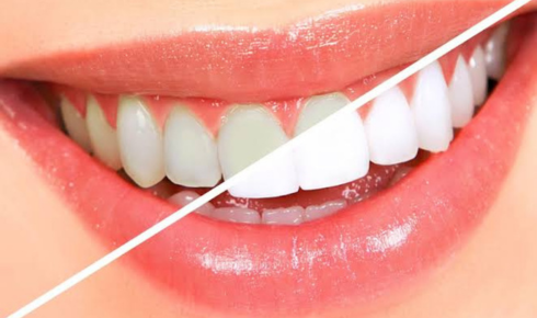 teeth bleaching Perth